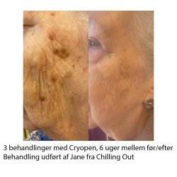 Cryopen Konkurrence Vinder