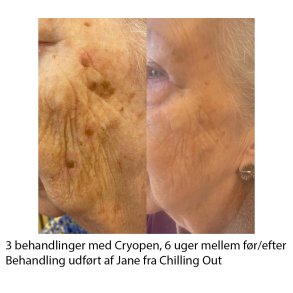 Cryopen Konkurrence Vinder