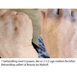 Cryopen Konkurrence Vinder