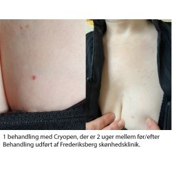 Cryopen Konkurrence Vinder